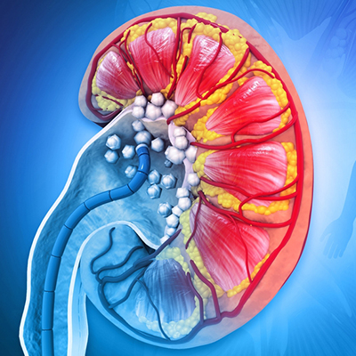 Kidney stones specialist in Vijayawada